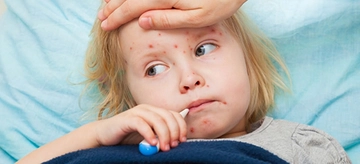 Çocuklarda Kızamık Belirtileri ve Tedavisi